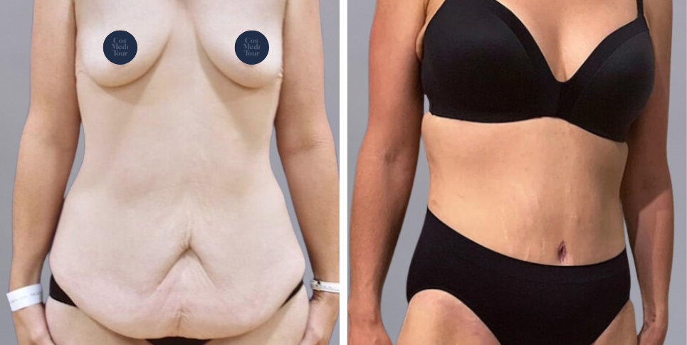 Mummy Makeover breast and abdomen combination before and after photo