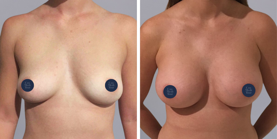 Breast Augmentation Boob Job before and after photo