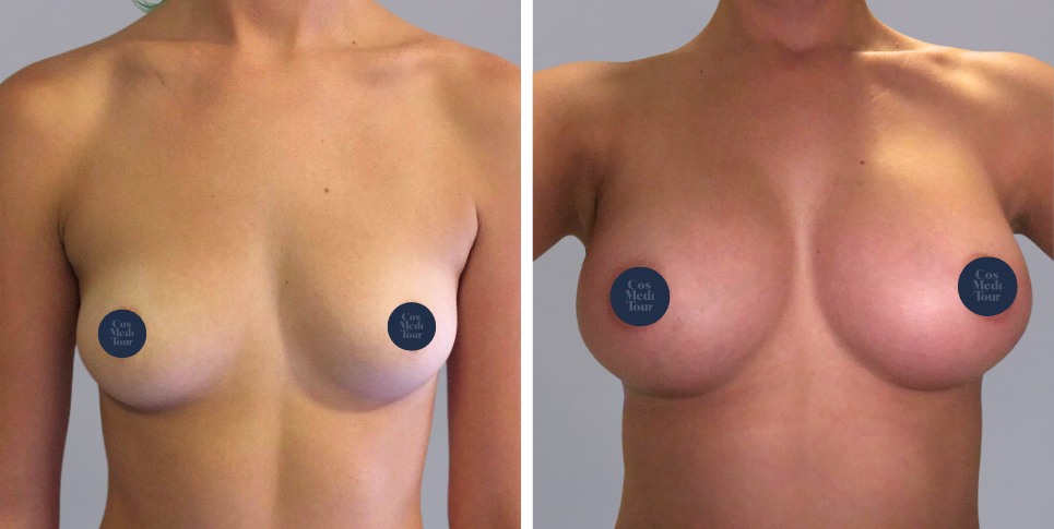 Breast Augmentation Boob Job before and after photo