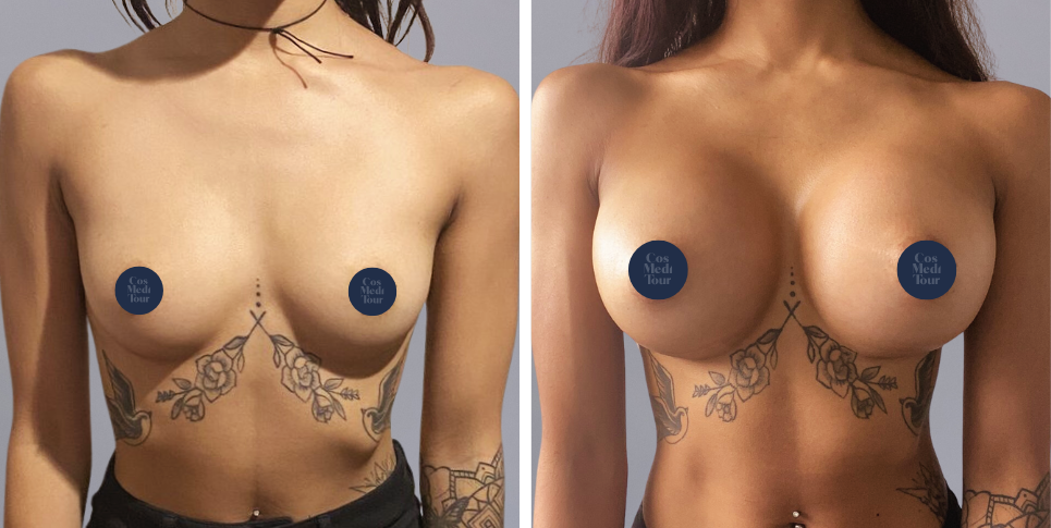 Breast Augmentation boob job before and after photo