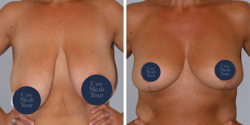 Breast Lift boob job before and after photo