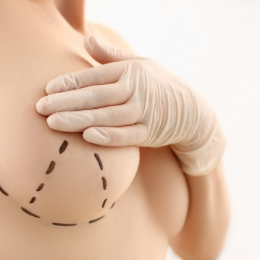 Breast Surgery Markups on a Woman
