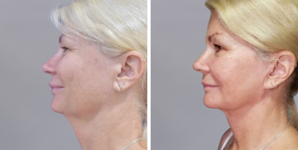 Face Lift Neck Lift before and after photo
