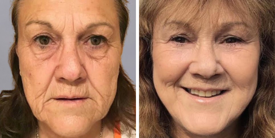 Face Lift Neck Lift before and after photo