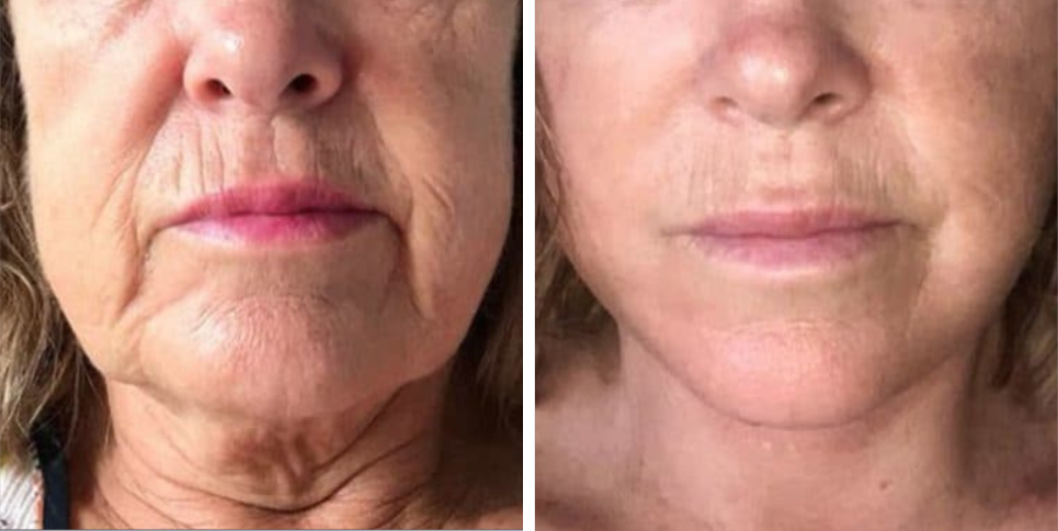 Face Lift Neck Lift before and after photo