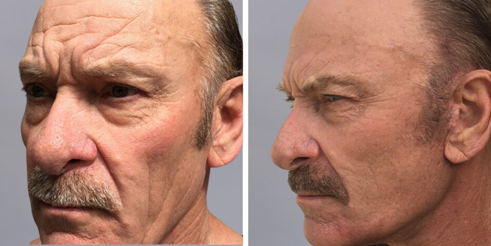 Face Lift Neck Lift before and after photo