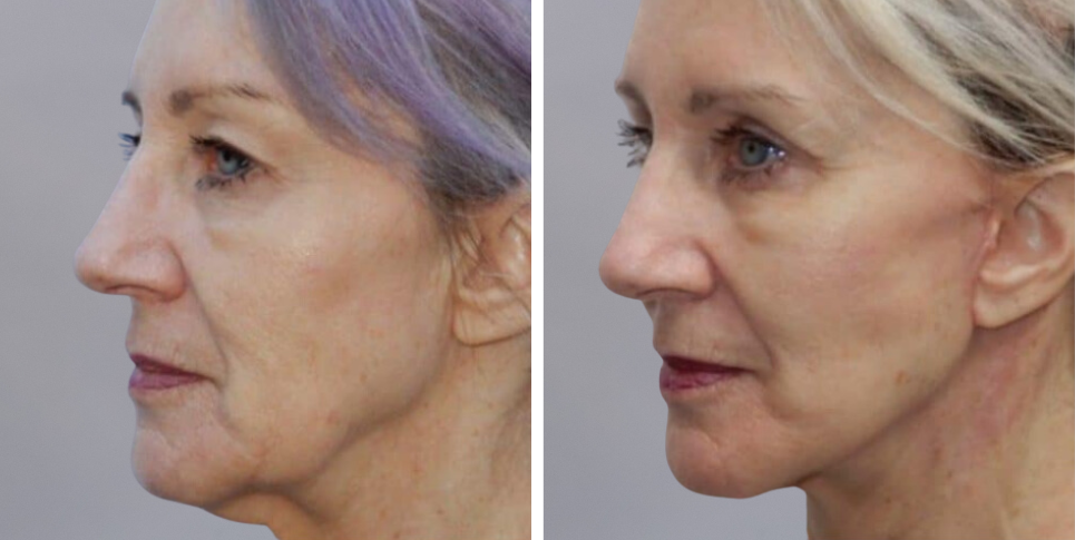Face Lift Neck Lift before and after photo