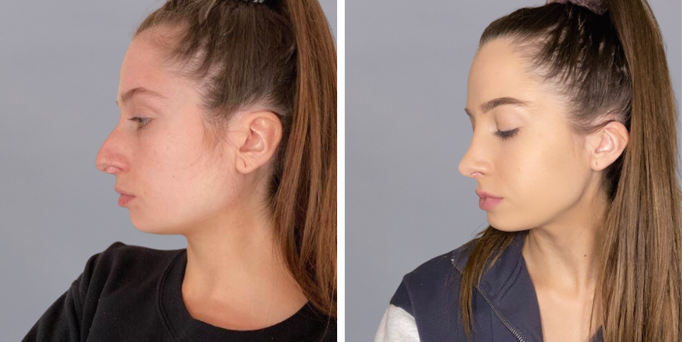 Rhinoplasty nose job before and after photo