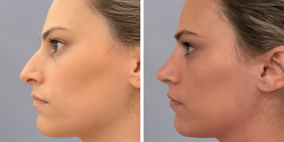 Rhinoplasty nose job before and after photo