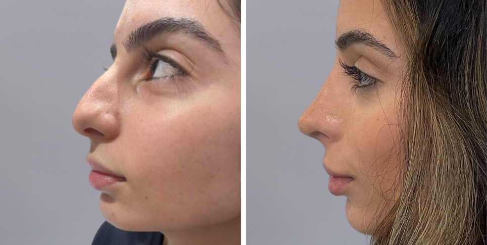 Rhinoplasty nose job before and after photo