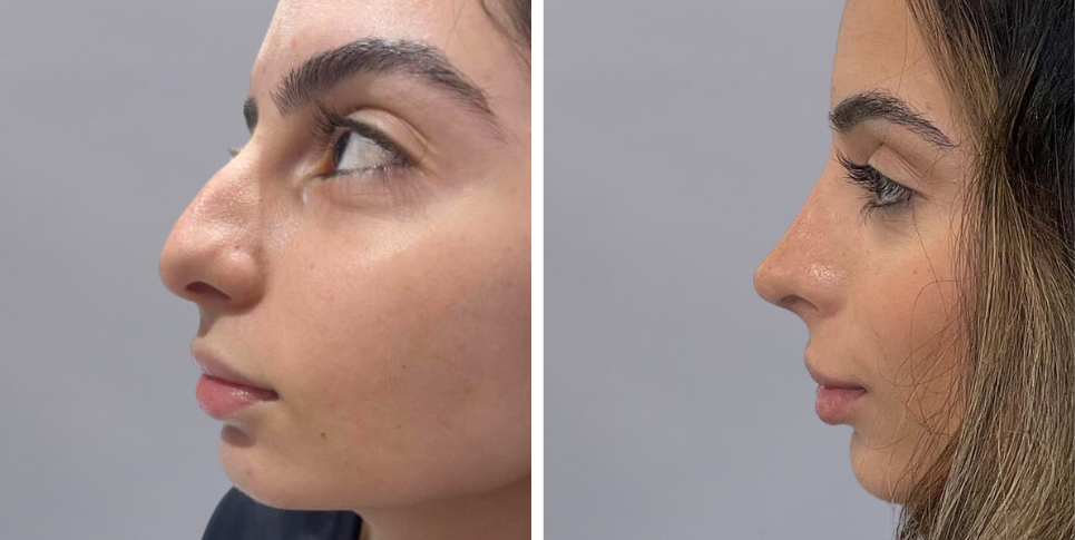 Rhinoplasty nose job before and after photo