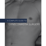 Guide to gynecomastia surgery