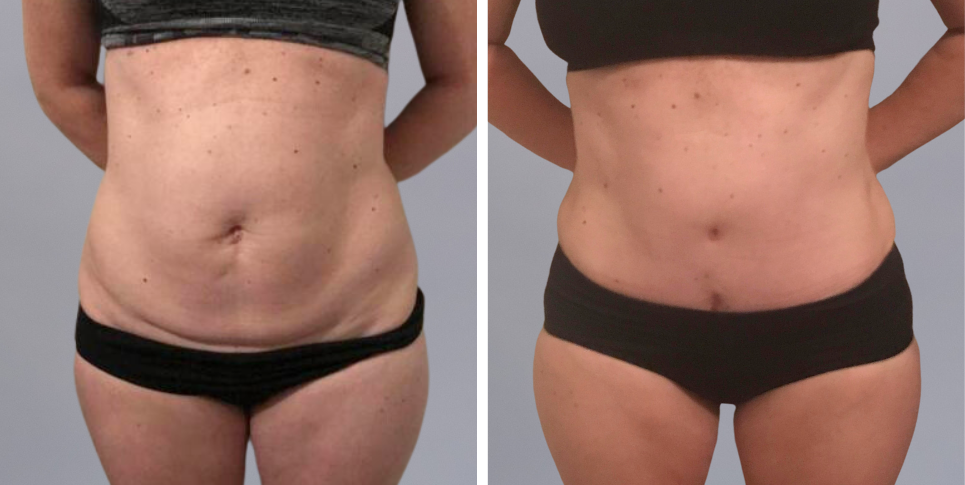 Tummy Tuck Abdominoplasty before and after photo