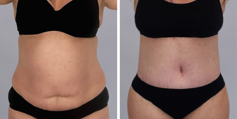 Tummy Tuck Abdominoplasty before and after photo