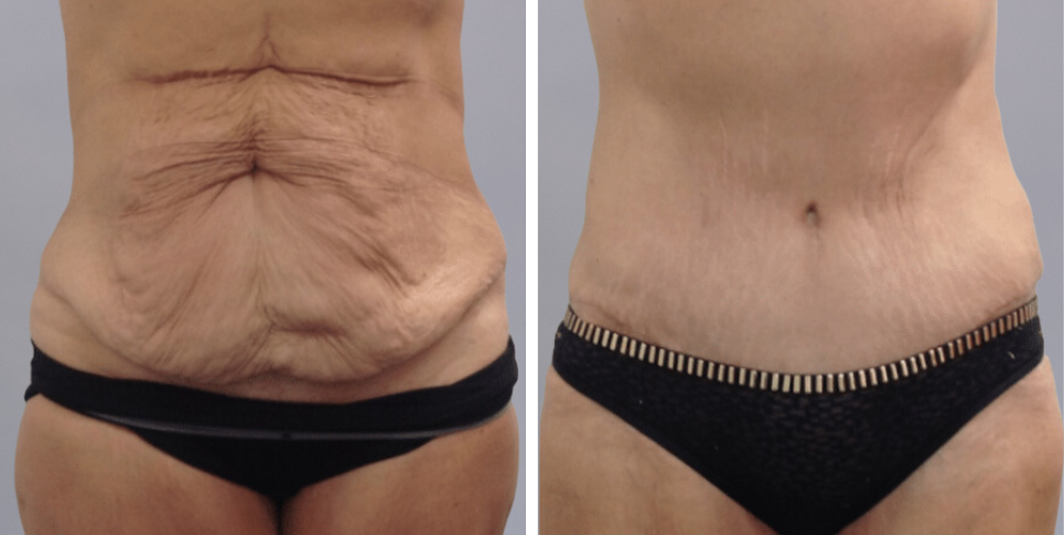 Tummy Tuck Abdominoplasty before and after photo