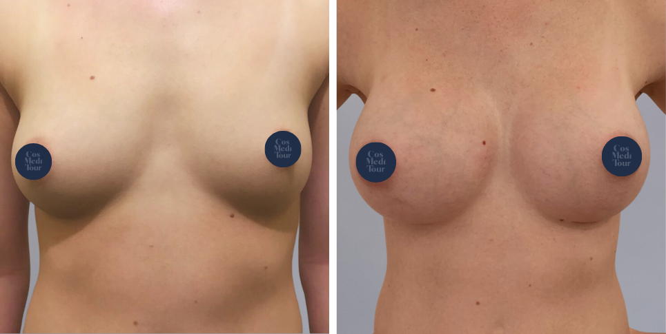 Breast Augmentation boob job before and after photo