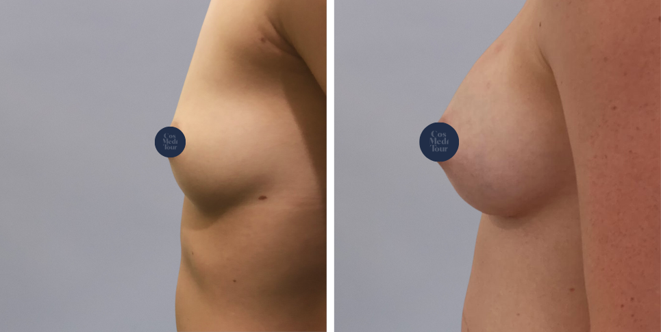 Breast Augmentation boob job before and after photo