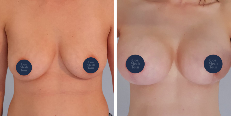 Breast Augmentation and breast lift breast augmentation plus lift boob job before and after photo