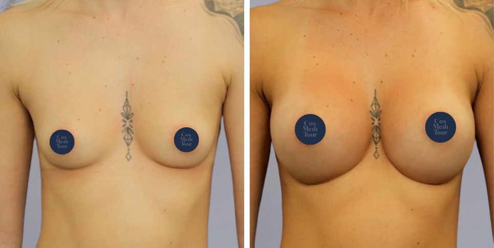 Breast Augmentation boob job before and after photo