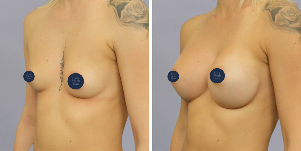 Breast Augmentation boob job before and after photo