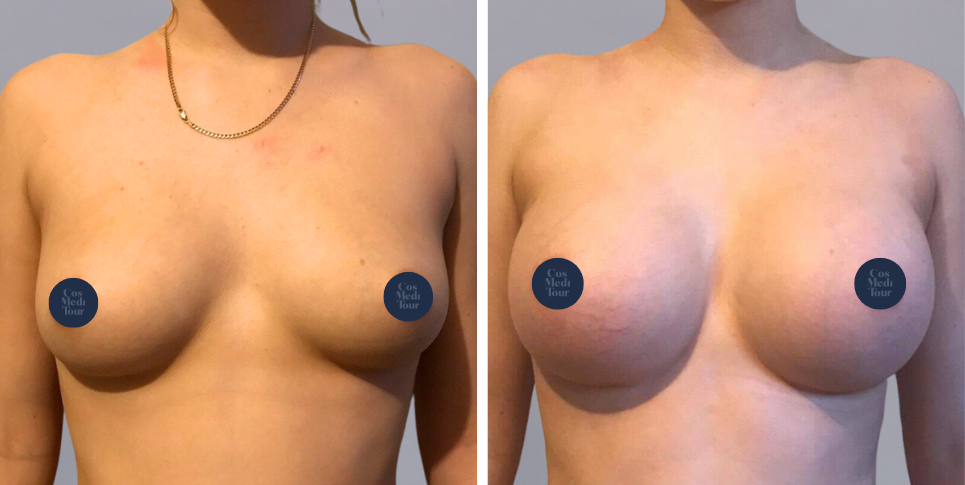 Breast Augmentation boob job before and after photo