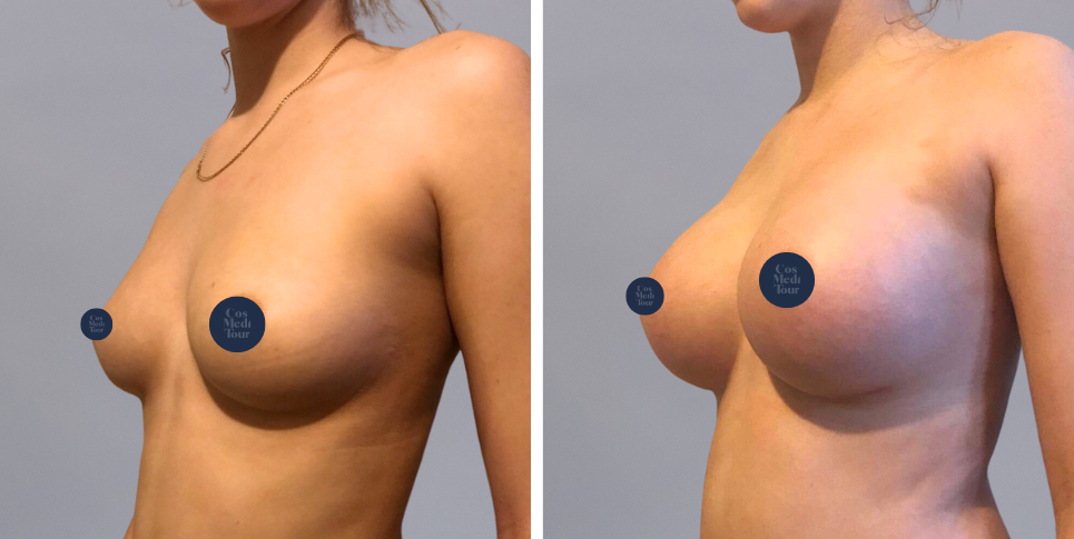 Breast Augmentation boob job before and after photo