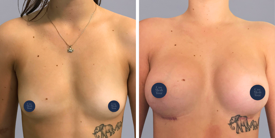 Breast Augmentation boob job before and after photo