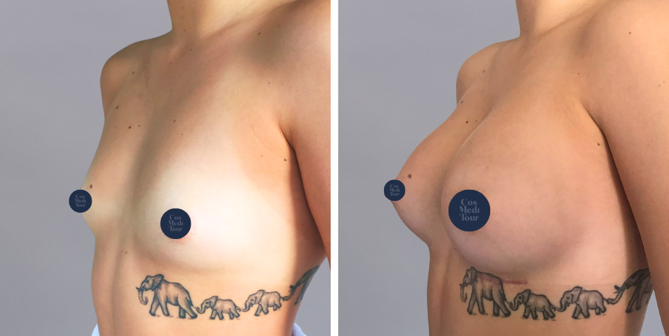 Breast Augmentation boob job before and after photo