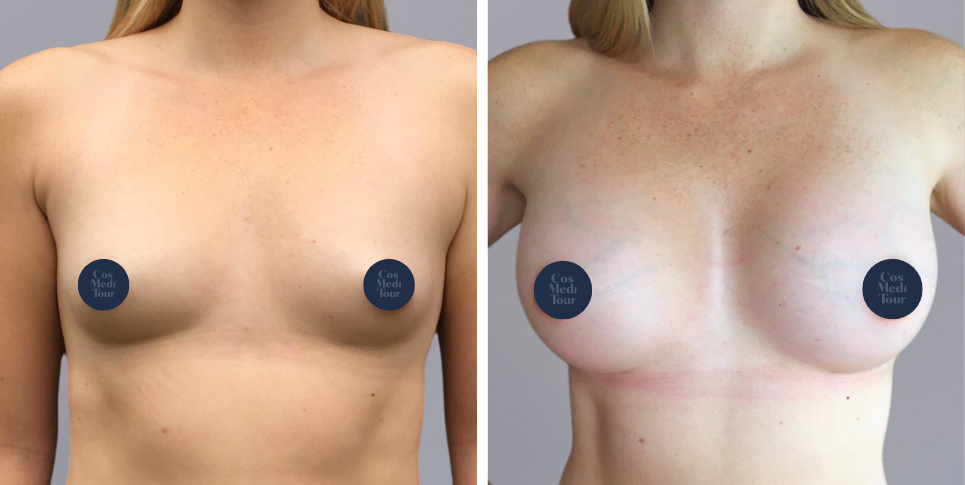 Breast Augmentation boob job before and after photo