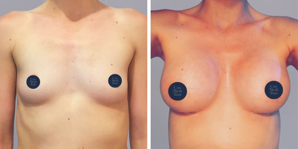 Breast Augmentation boob job before and after photo