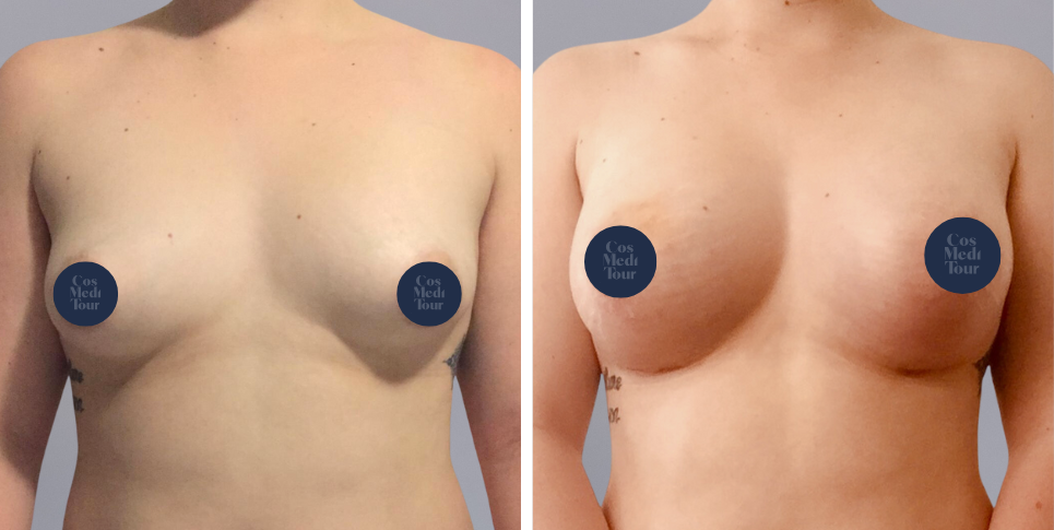 Breast Augmentation boob job before and after photo