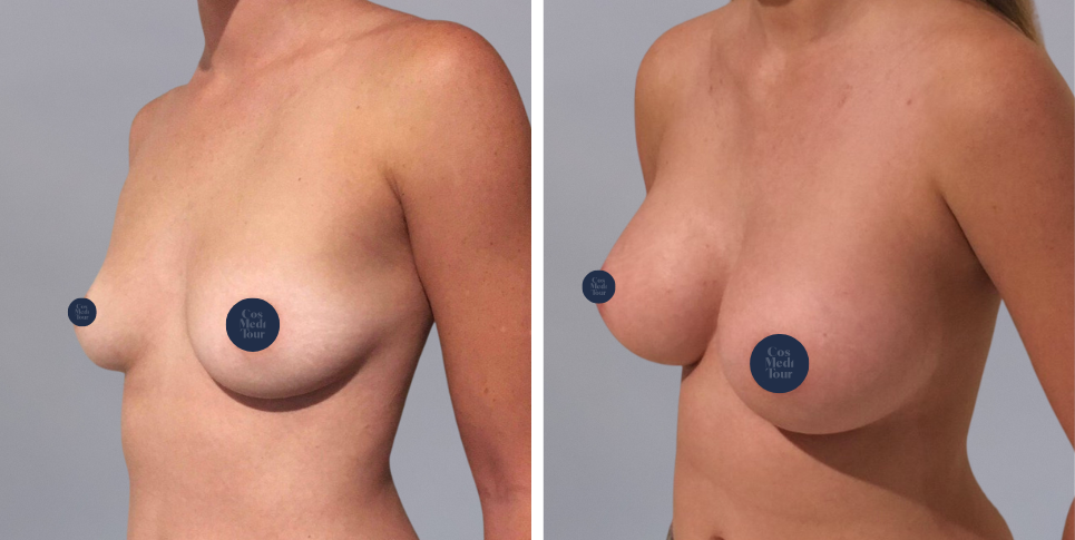 Breast Augmentation Boob Job before and after photo