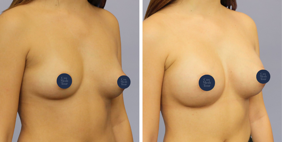 Breast Augmentation boob job before and after photo