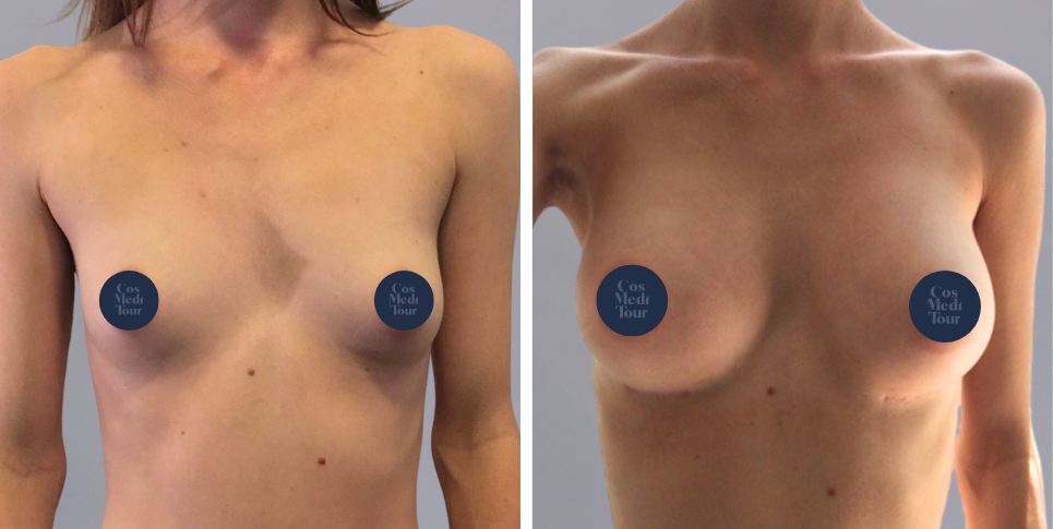 Breast Augmentation boob job before and after photo