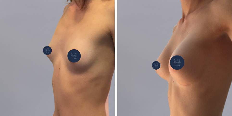 Breast Augmentation boob job before and after photo