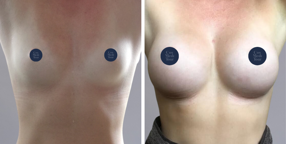 Breast Augmentation boob job before and after photo