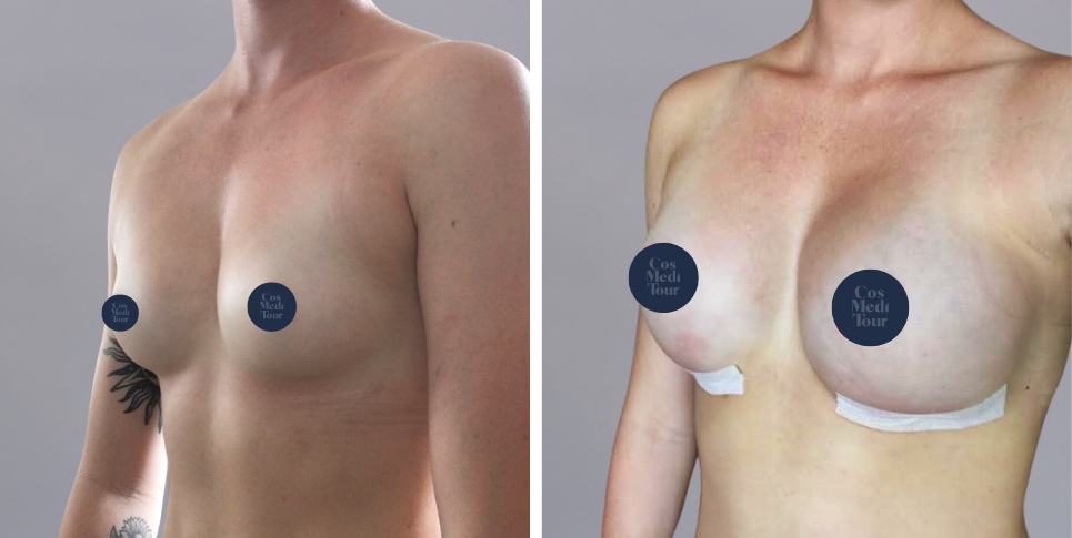 Breast Augmentation boob job before and after photo