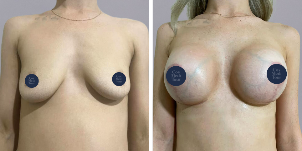 Breast Augmentation and breast lift breast augmentation plus lift boob job before and after photo