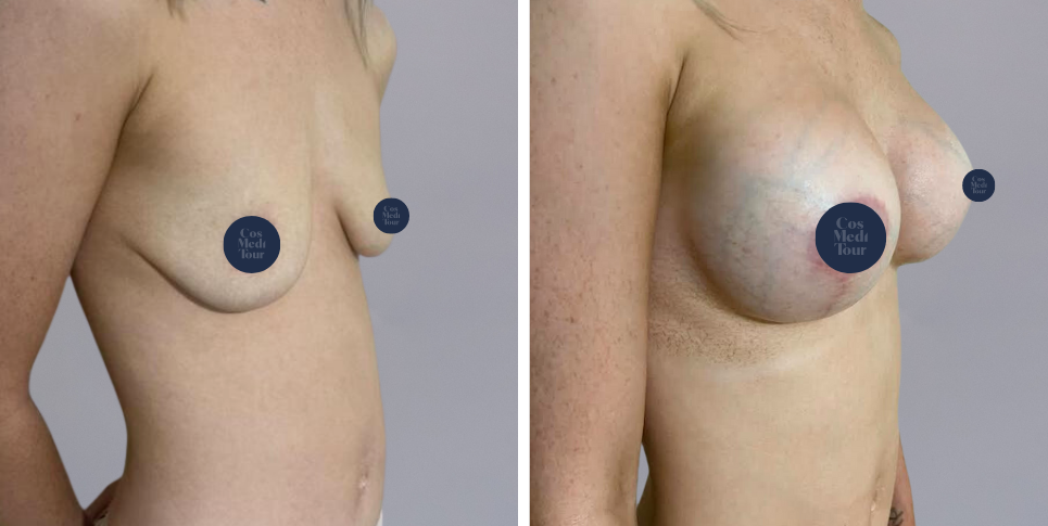 Breast Augmentation and breast lift breast augmentation plus lift boob job before and after photo