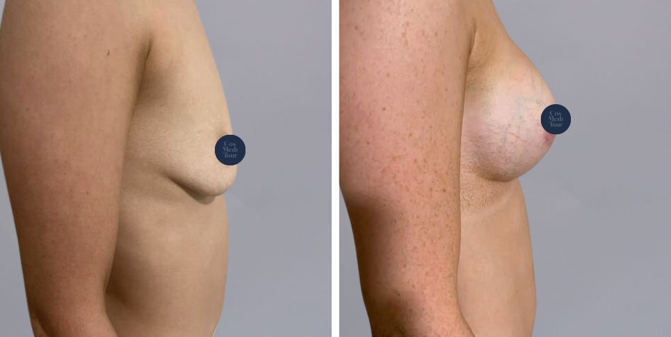 Breast Augmentation and breast lift breast augmentation plus lift boob job before and after photo