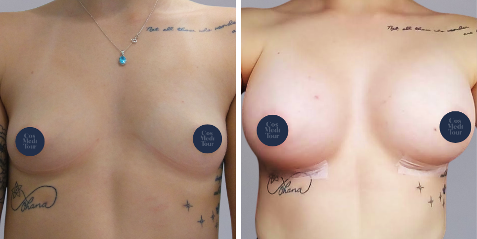 Breast Augmentation boob job before and after photo