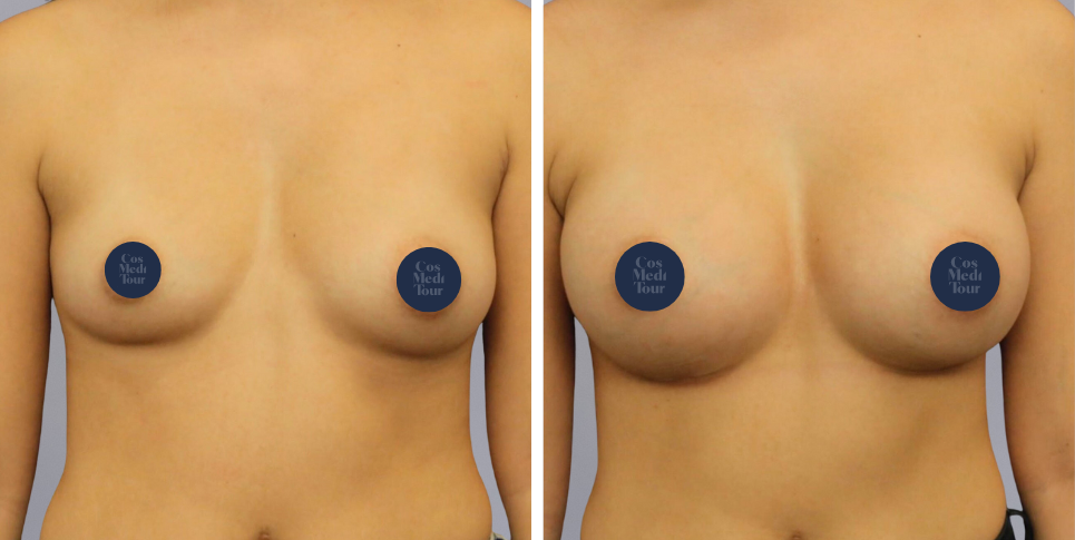 Breast Augmentation boob job before and after photo