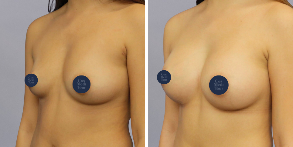 Breast Augmentation boob job before and after photo