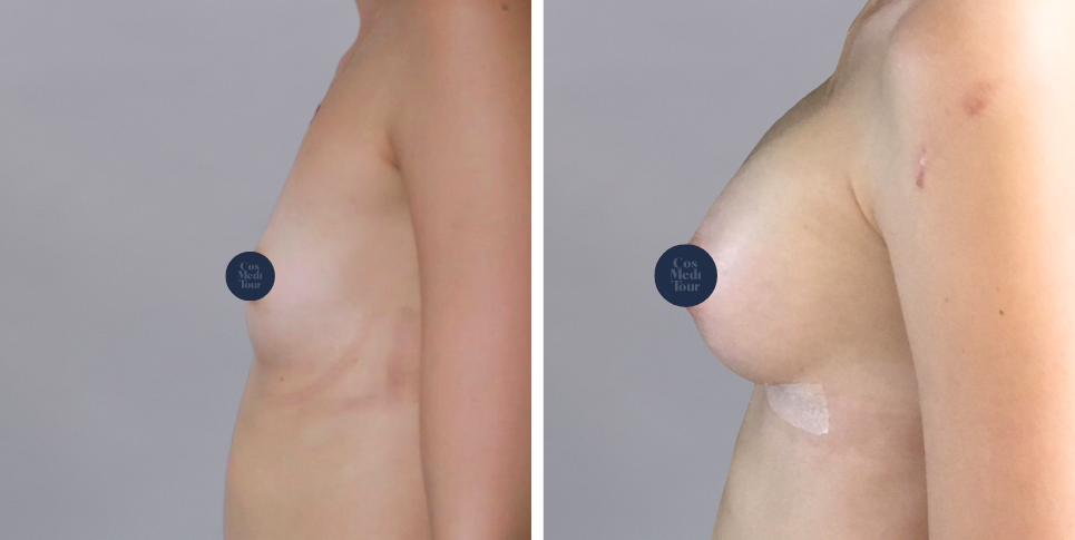 Breast Augmentation boob job before and after photo