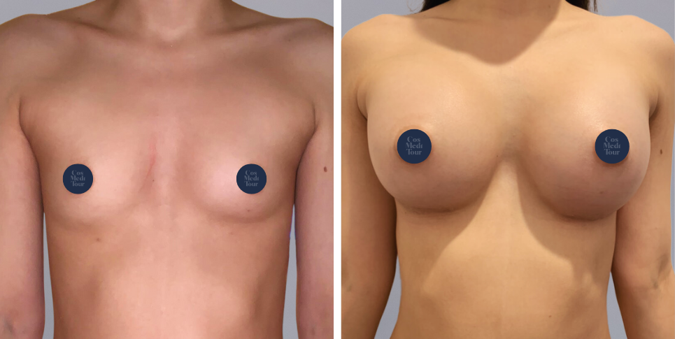 Breast Augmentation boob job before and after photo