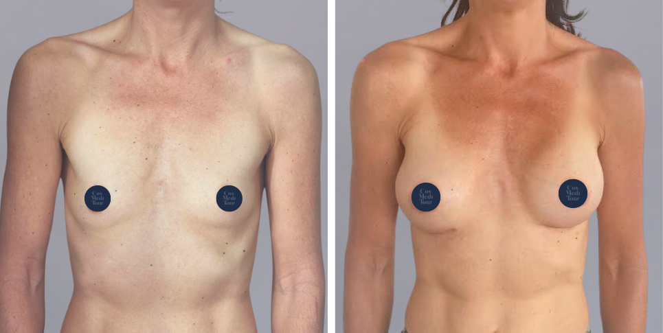 Breast Augmentation boob job before and after photo