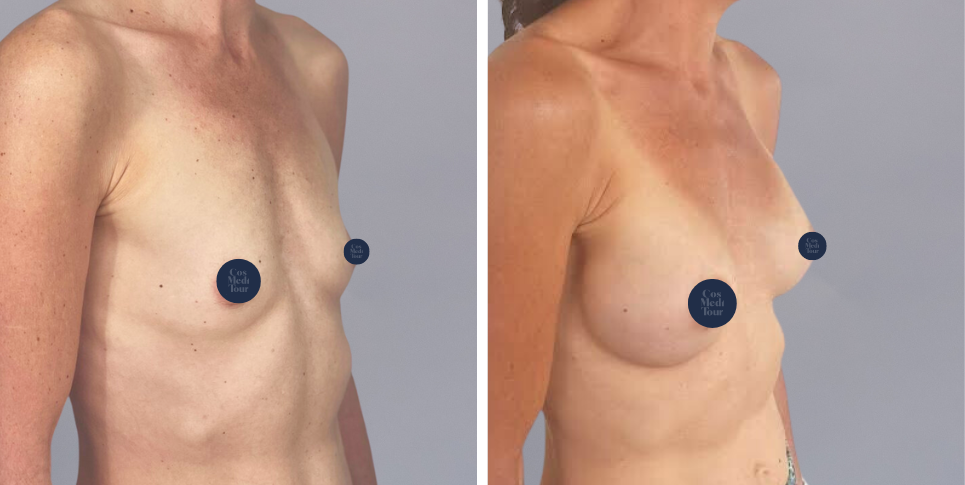 Breast Augmentation boob job before and after photo