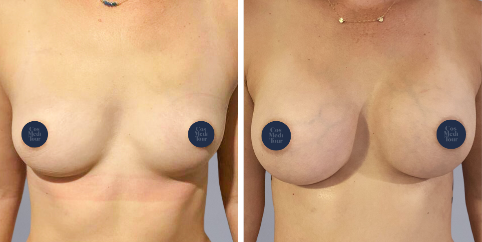 Breast Augmentation boob job before and after photo