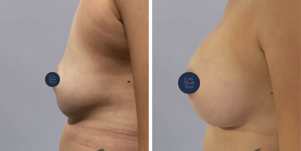 Breast Augmentation boob job before and after photo