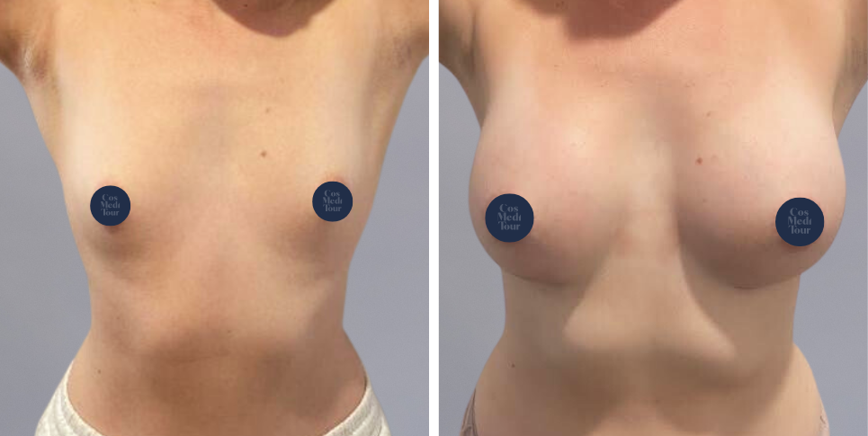 Breast Augmentation boob job before and after photo